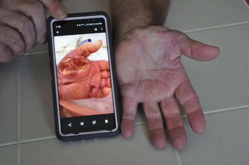 Vibrio vulnificus anh 3