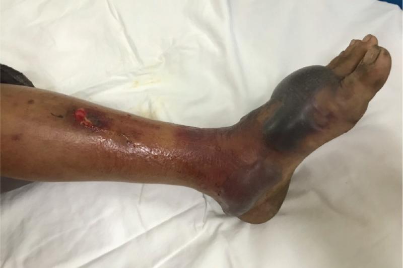 Vibrio vulnificus anh 1