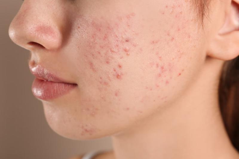 Dau hieu luoi van dong anh 5