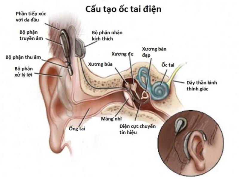 phau thuat cay oc tai anh 2