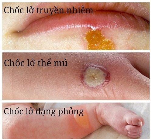 Thuoc tri choc lo anh 1