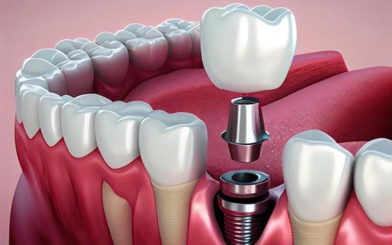 Implant anh 1