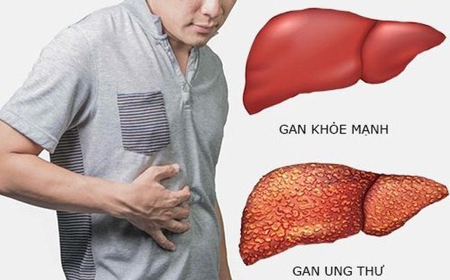 benh ung thu anh 1