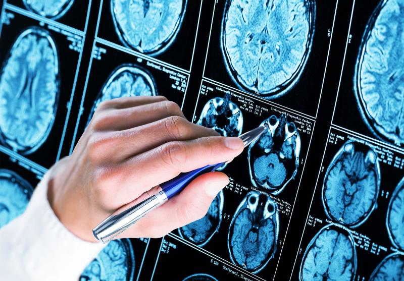 Bệnh nhân Alzheimer trẻ nhất ảnh 1