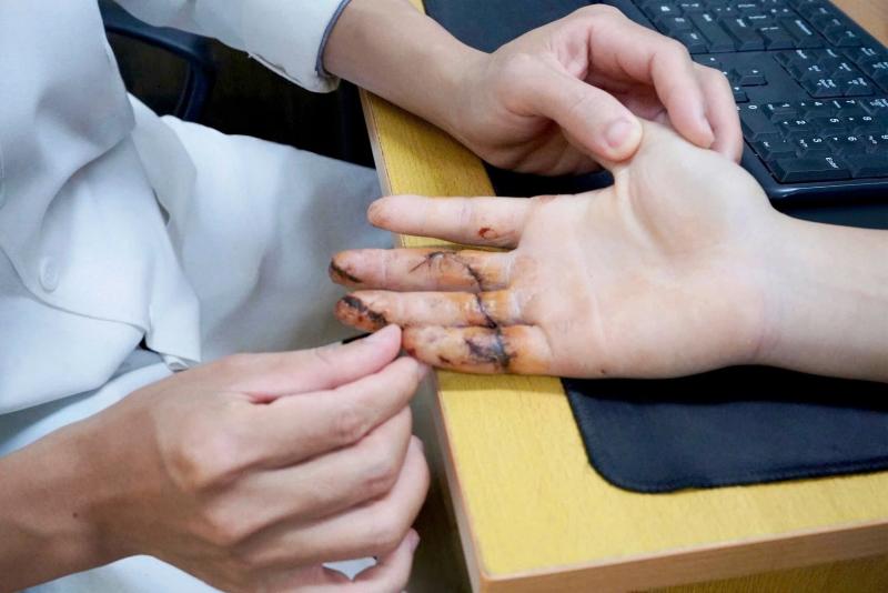 mất 3 ngón tay ảnh 1
