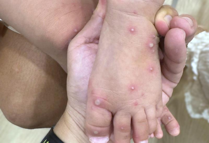 Vaccine tay chân miệng ảnh 2